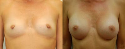 Breast Augmentation Before & After Gallery - Patient 315202 - Image 1