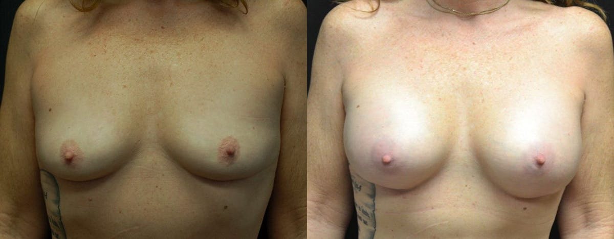 Breast Augmentation Before & After Gallery - Patient 255749 - Image 1