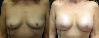 Breast Augmentation Before & After Gallery - Patient 255749 - Image 1