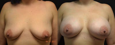 Breast Augmentation Before & After Gallery - Patient 350707 - Image 1