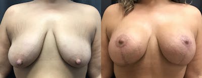 Breast Augmentation Before & After Gallery - Patient 138956 - Image 1