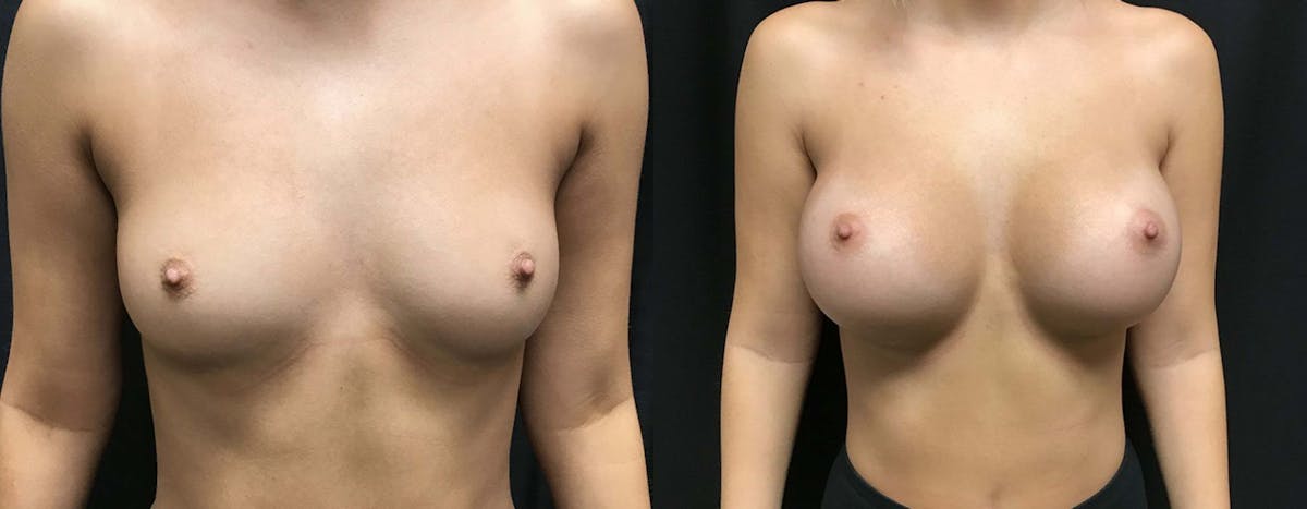Breast Augmentation Before & After Gallery - Patient 458064 - Image 1