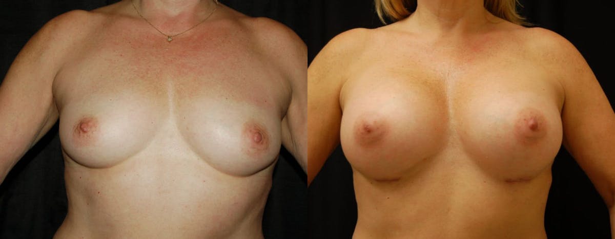 Breast Augmentation Before & After Gallery - Patient 291708 - Image 1