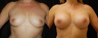 Breast Augmentation Before & After Gallery - Patient 291708 - Image 1