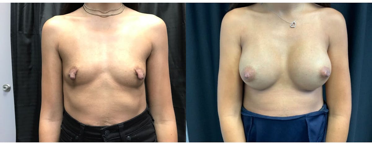 Breast Augmentation Before & After Gallery - Patient 168009 - Image 1