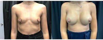 Breast Augmentation Before & After Gallery - Patient 168009 - Image 1