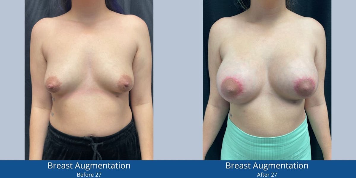 Breast Augmentation Before & After Gallery - Patient 225223 - Image 1