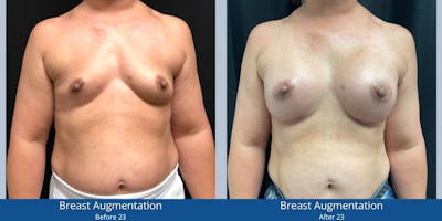 Breast Augmentation Before & After Gallery - Patient 164811 - Image 1