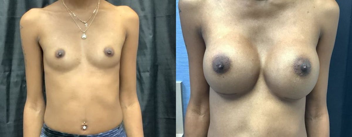 Breast Augmentation Before & After Gallery - Patient 129497 - Image 1