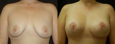 Breast Augmentation Before & After Gallery - Patient 261318 - Image 1