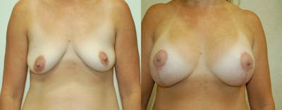 Breast Augmentation Before & After Gallery - Patient 271944 - Image 1