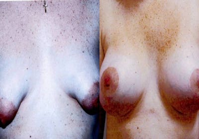 Breast Augmentation Before & After Gallery - Patient 200661 - Image 1