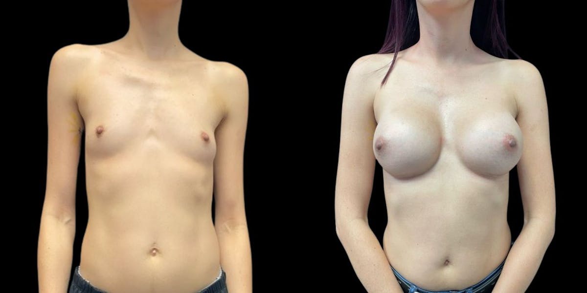 Breast Augmentation Before & After Gallery - Patient 256876 - Image 1