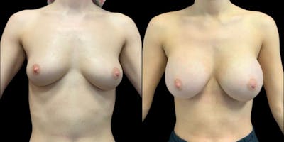 Breast Augmentation Before & After Gallery - Patient 161953 - Image 1