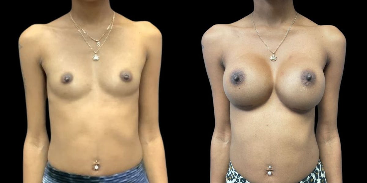 Breast Augmentation Before & After Gallery - Patient 353143 - Image 1