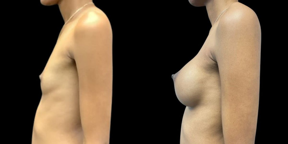 Breast Augmentation Before & After Gallery - Patient 151719 - Image 1