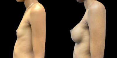 Breast Augmentation Before & After Gallery - Patient 151719 - Image 1
