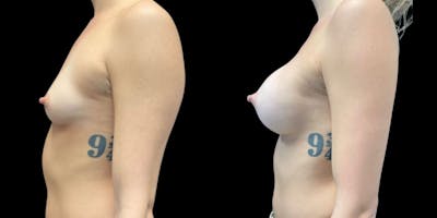 Breast Augmentation Before & After Gallery - Patient 569936 - Image 1