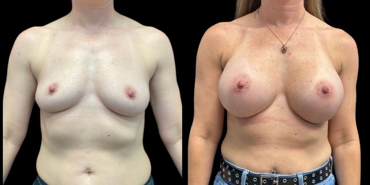 Breast Augmentation Before & After Gallery - Patient 142931 - Image 1