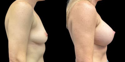 Breast Augmentation Before & After Gallery - Patient 325992 - Image 1