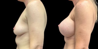 Breast Augmentation Before & After Gallery - Patient 421151 - Image 1