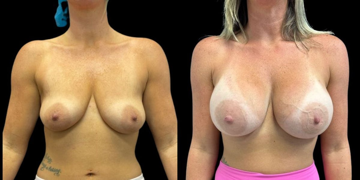 Breast Augmentation Before & After Gallery - Patient 147725 - Image 1