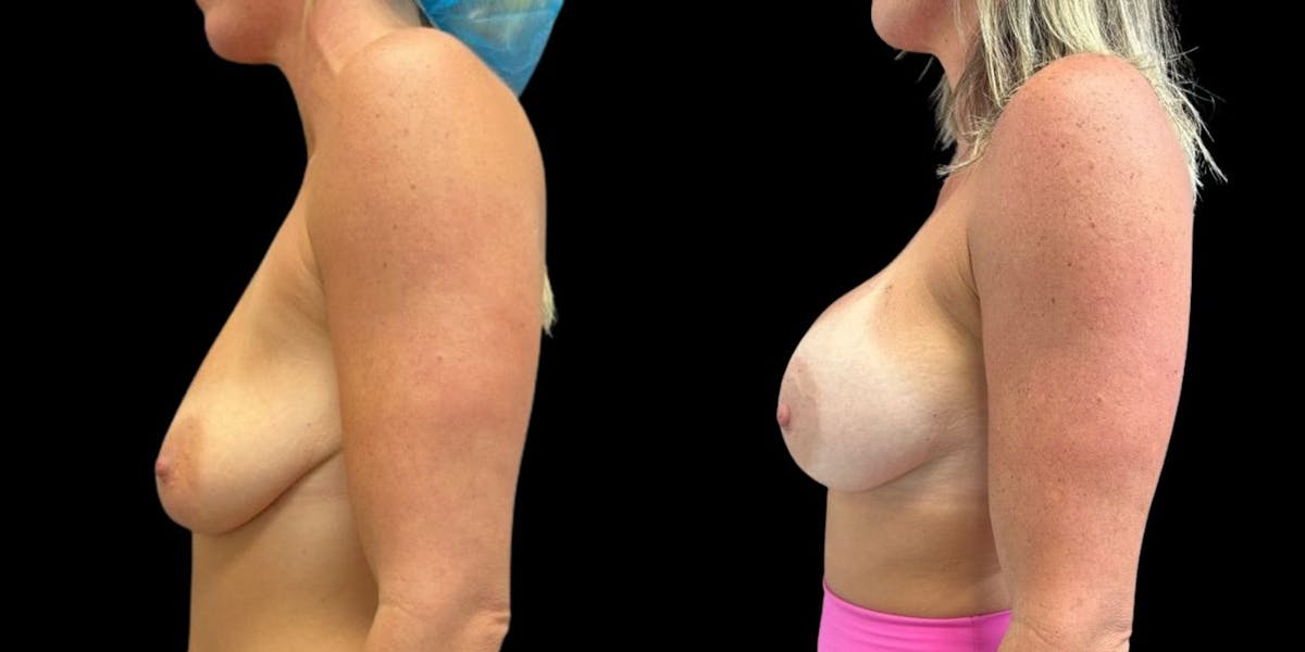 Breast Augmentation Before & After Gallery - Patient 199105 - Image 1