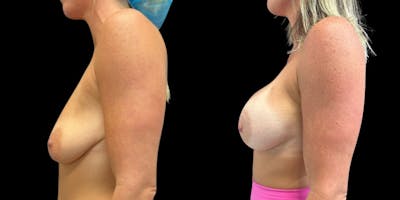 Breast Augmentation Before & After Gallery - Patient 199105 - Image 1