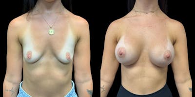 Breast Augmentation Before & After Gallery - Patient 323314 - Image 1