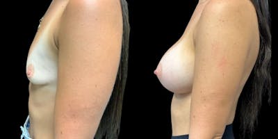 Breast Augmentation Before & After Gallery - Patient 370150 - Image 1