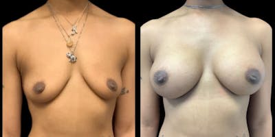Breast Augmentation Before & After Gallery - Patient 232982 - Image 1