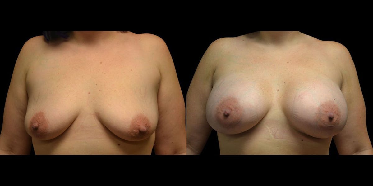 Breast Augmentation Before & After Gallery - Patient 291544 - Image 1
