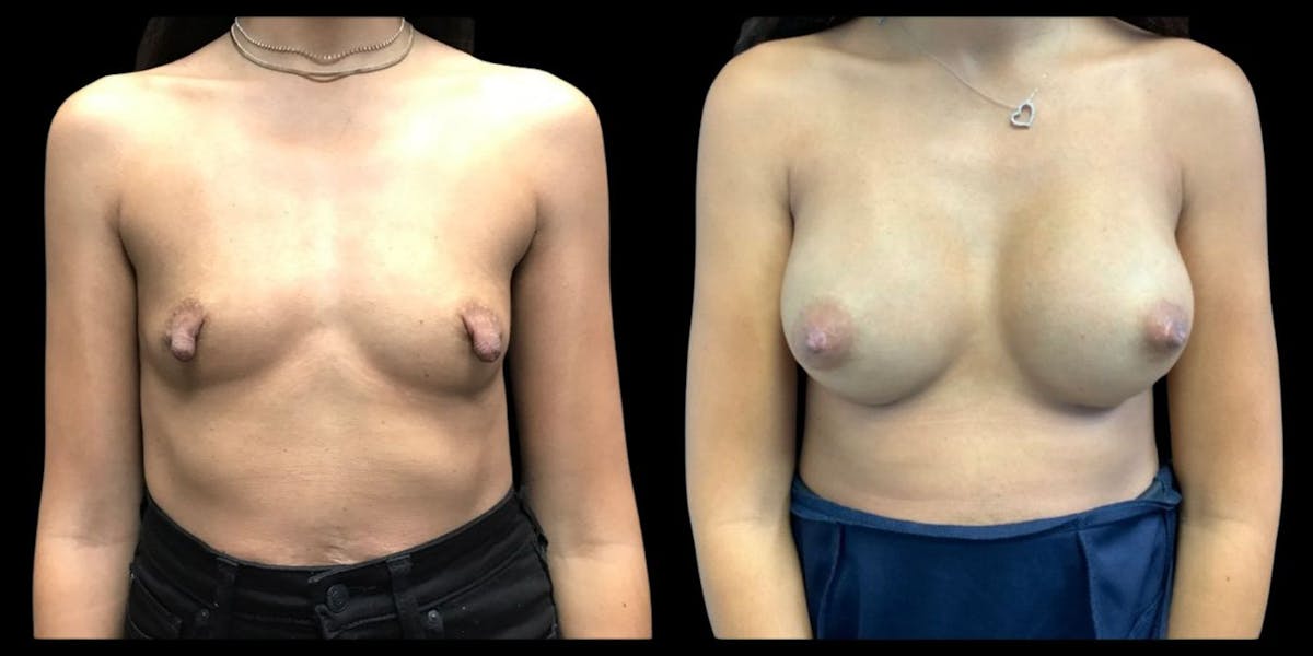 Breast Augmentation Before & After Gallery - Patient 487835 - Image 1