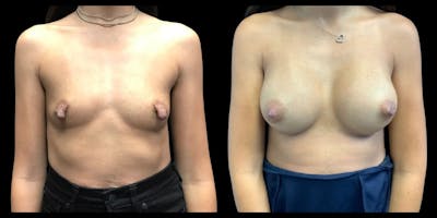 Breast Augmentation Before & After Gallery - Patient 487835 - Image 1