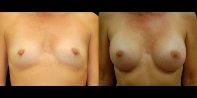 Breast Augmentation Before & After Gallery - Patient 369020 - Image 1