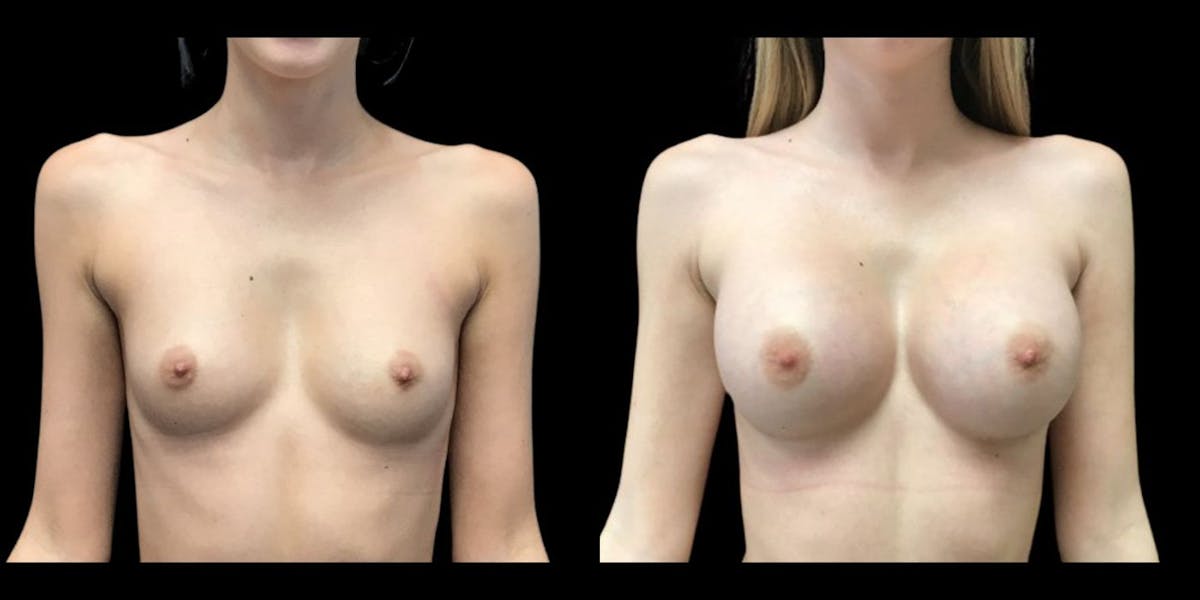 Breast Augmentation Before & After Gallery - Patient 265131 - Image 1