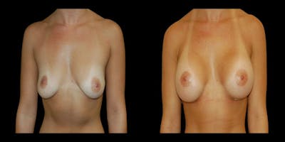 Breast Augmentation Before & After Gallery - Patient 303478 - Image 1