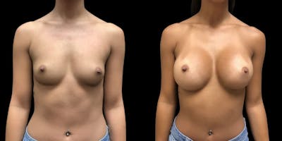 Breast Augmentation Before & After Gallery - Patient 153336 - Image 1