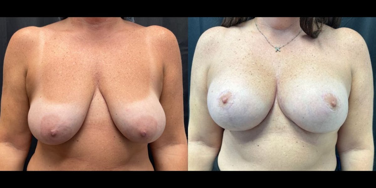 Breast Augmentation with Lift Before & After Gallery - Patient 106751 - Image 1