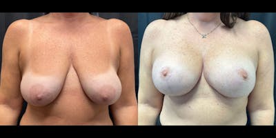 Breast Augmentation with Lift Before & After Gallery - Patient 106751 - Image 1