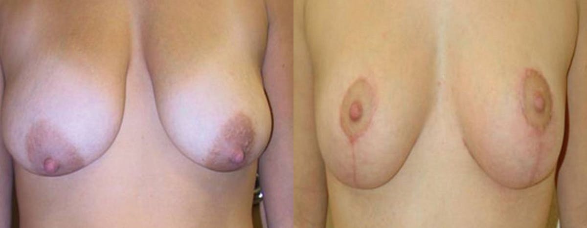 Breast Lift Before & After Gallery - Patient 272995 - Image 1