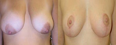 Breast Lift Before & After Gallery - Patient 272995 - Image 1