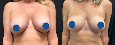 Breast Lift Before & After Gallery - Patient 367532 - Image 1