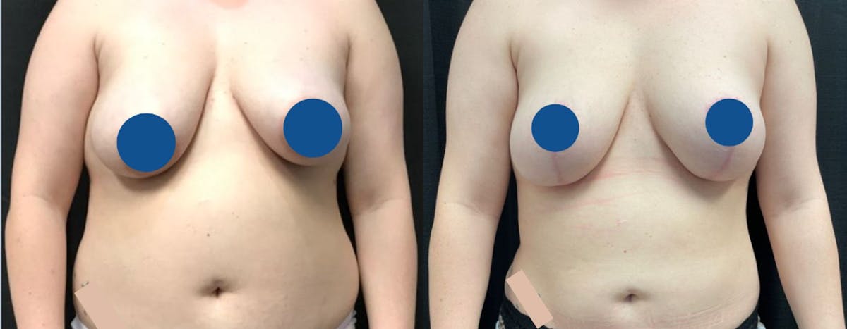 Breast Lift Before & After Gallery - Patient 239959 - Image 1