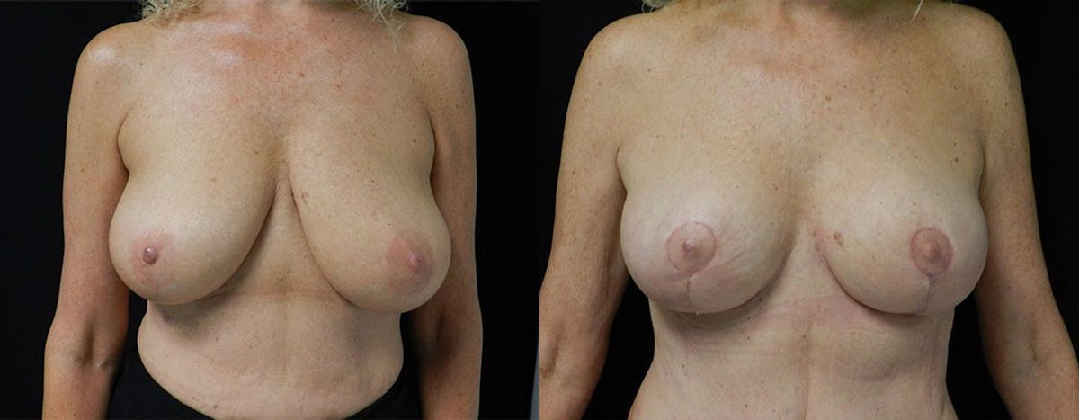 Breast Lift Before & After Gallery - Patient 386118 - Image 1