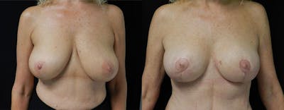 Breast Lift Before & After Gallery - Patient 386118 - Image 1