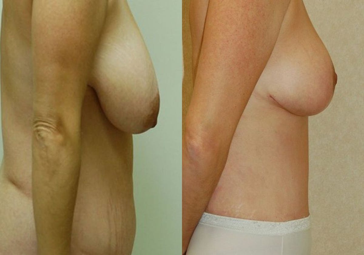Breast Lift Before & After Gallery - Patient 894945 - Image 1