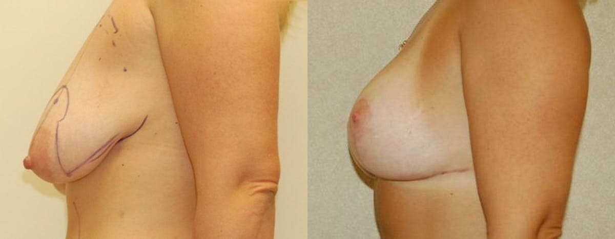 Breast Lift Before & After Gallery - Patient 244008 - Image 1