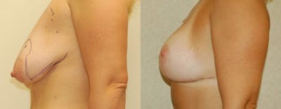 Breast Lift Before & After Gallery - Patient 244008 - Image 1