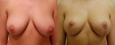 Breast Lift Before & After Gallery - Patient 925683 - Image 1